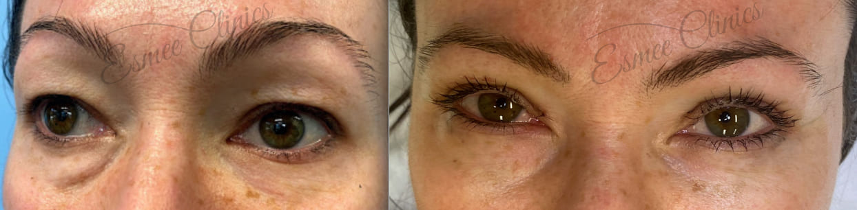 Before and After img